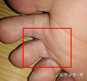这是汗疱疹还是脚气?