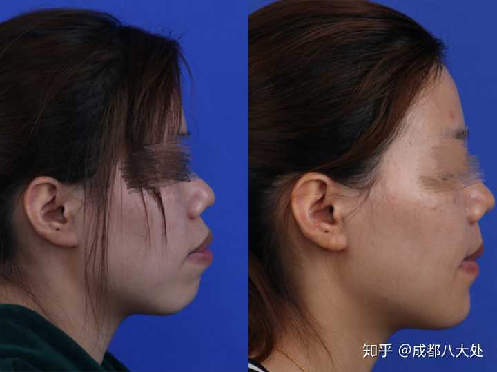 整形削骨有后遗症吗?