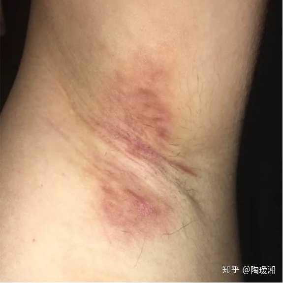 做狐臭手术需要多少钱啊?