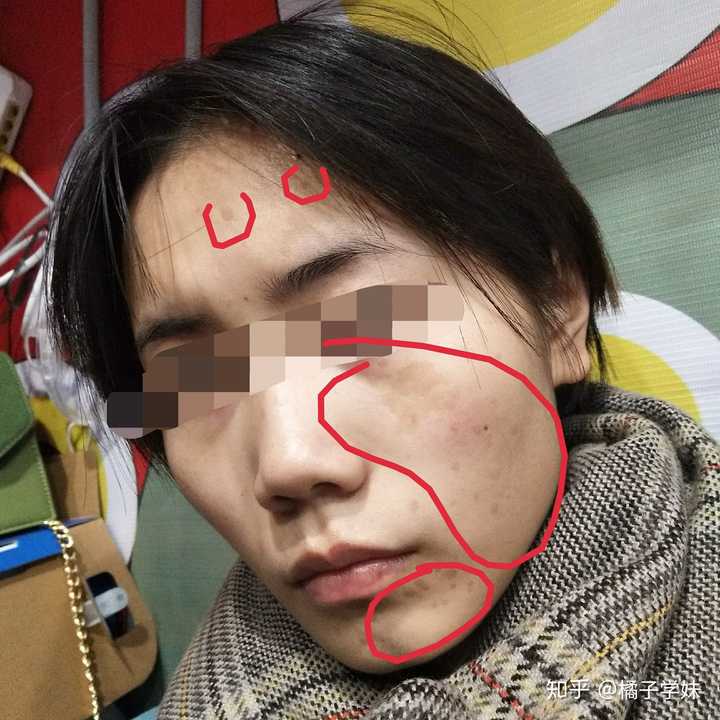脸上有胎记是一种怎样的体验?