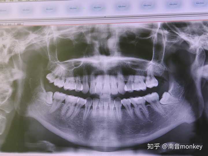 昨天去医院补龋齿顺便拍了个片子,结果发现也长了两颗阻生智齿.