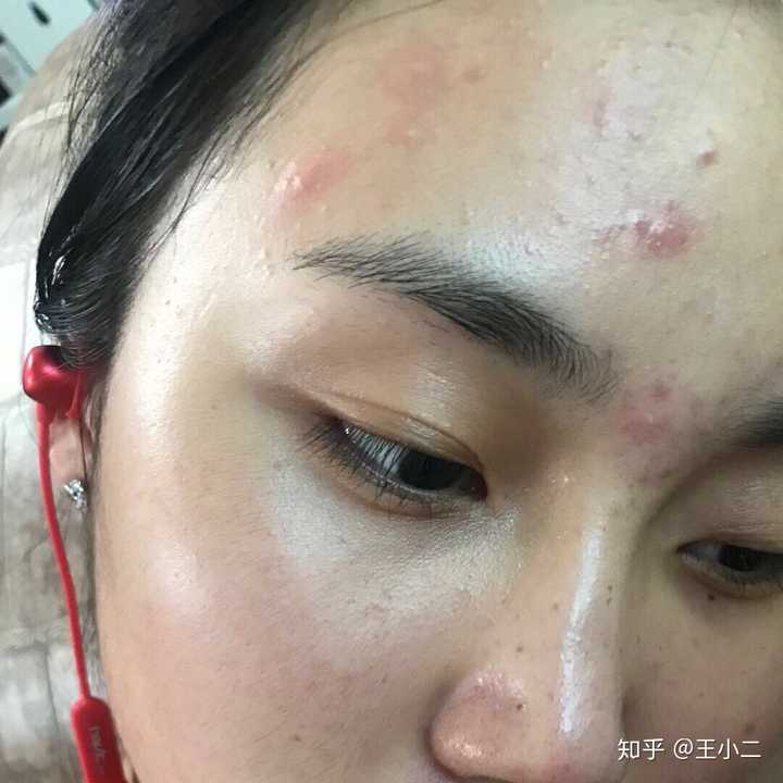 为什么一喝牛奶就长痘痘?