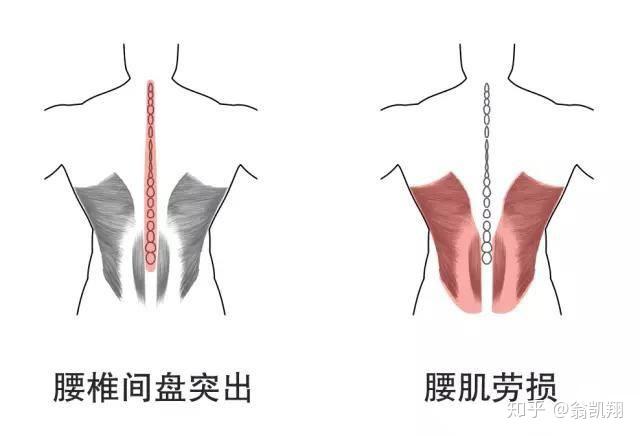 坐靠垫是否能够有效缓解腰肌劳损或者是腰间盘突出?