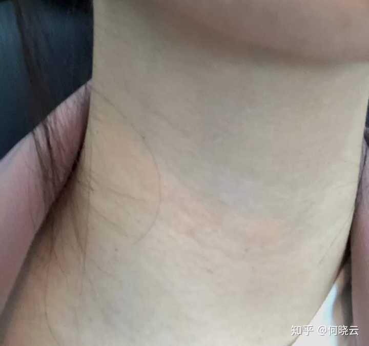 脖子为什么长疣子?