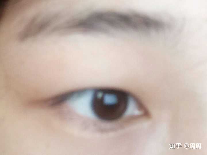 内双 肿眼泡是什么样的感觉?