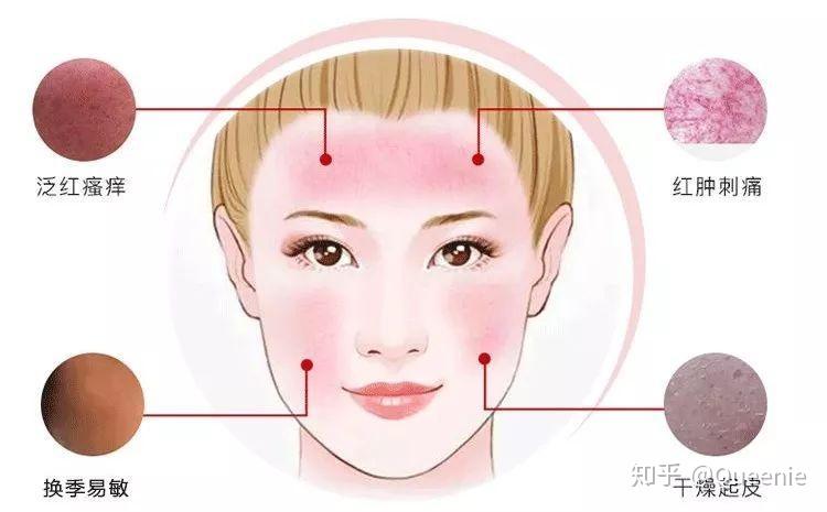肌肤红肿发炎,就连脸颊等易干燥部位也开始长痘,这就导致了油性敏感