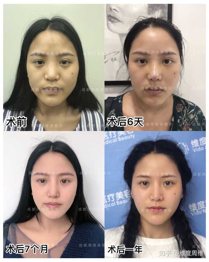鼻孔一大一小,怎么办?