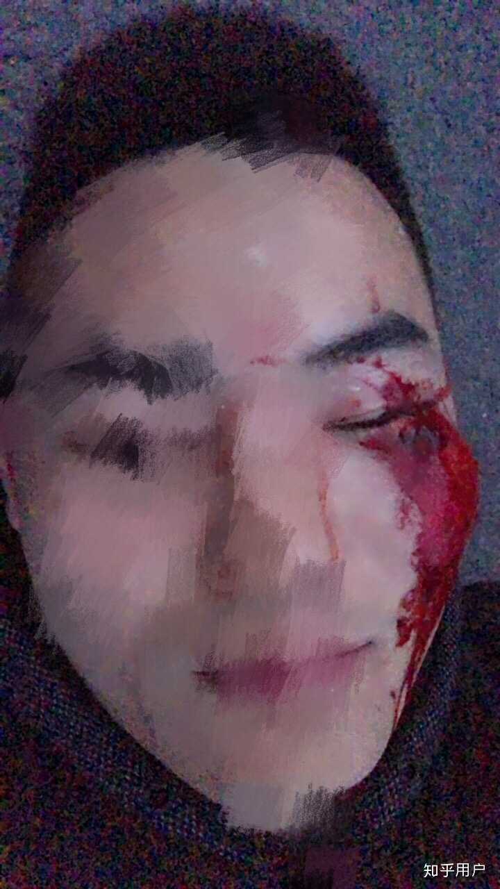单眼失明是种怎样的体验?