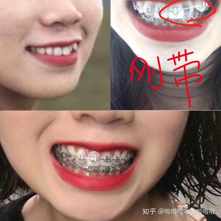 女孩子带牙套会很丑嘛?