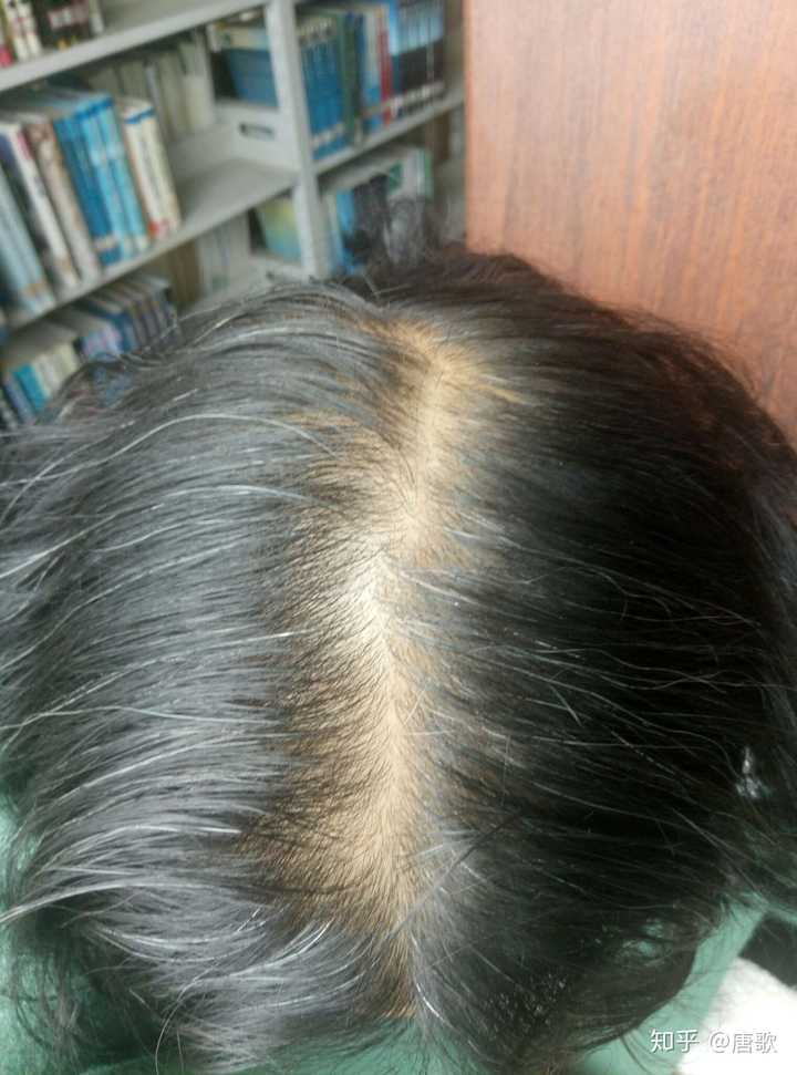 女生头顶头发少是什么体验 ?