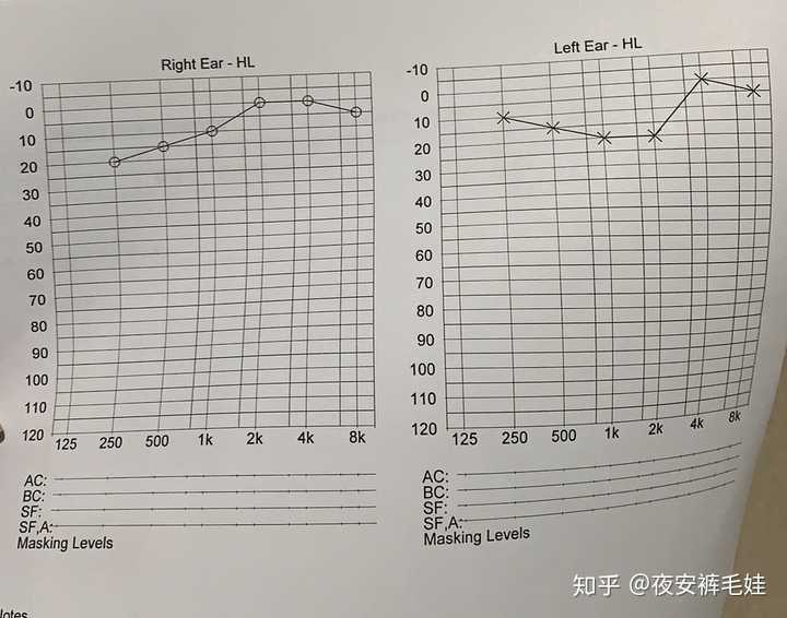 得突发性耳聋是什么样的体验?