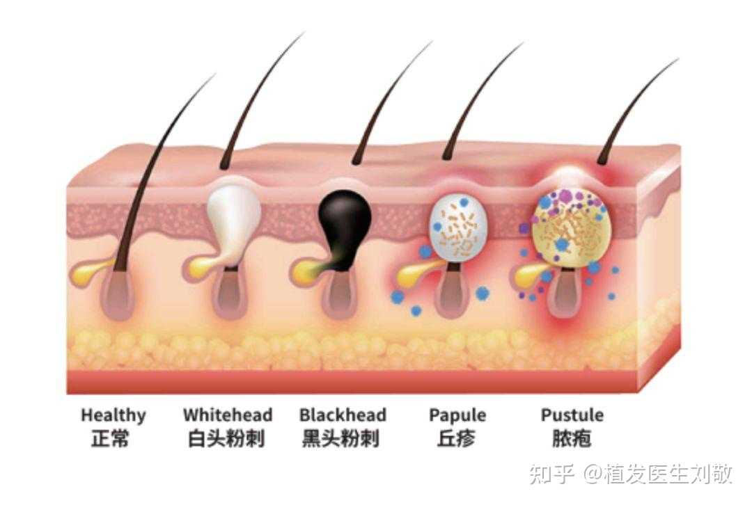 植发医生刘敬 的想法: 健康的毛囊什么样? 健康的毛囊