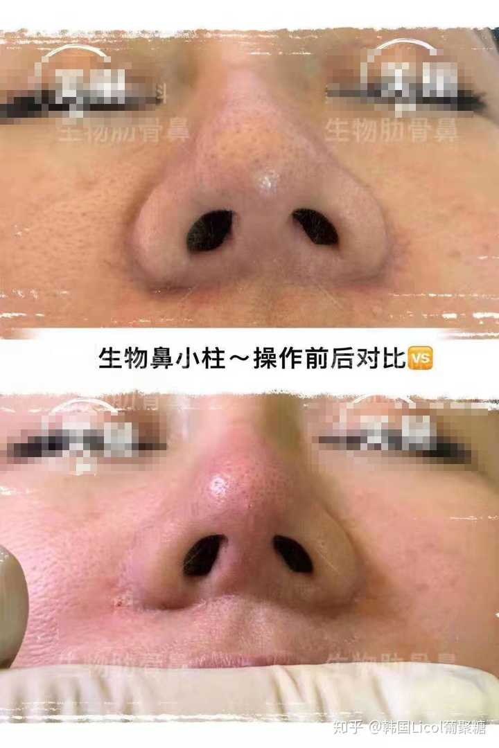 葡聚糖隆鼻靠谱吗?有没有用葡聚糖隆过鼻的小伙伴啊?