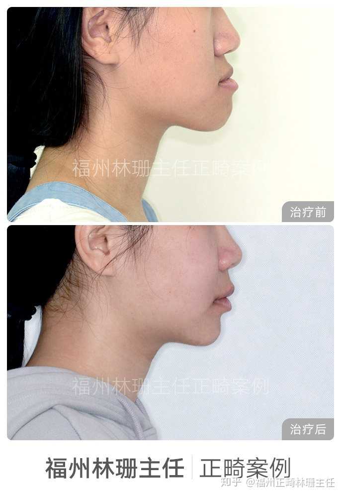 患者术前地包天(反颌),下颌前突,显得脸型较长,看起来换协调.