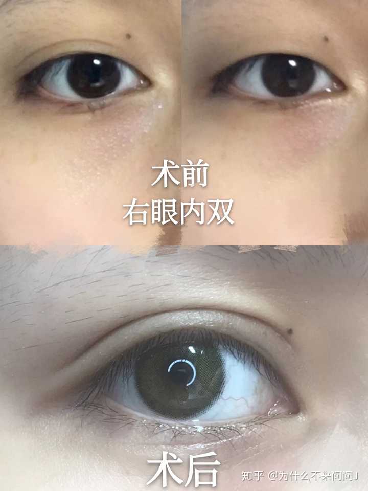 图中求美者 术前左眼外双, 右眼内双,两边不对称,做全切改造.