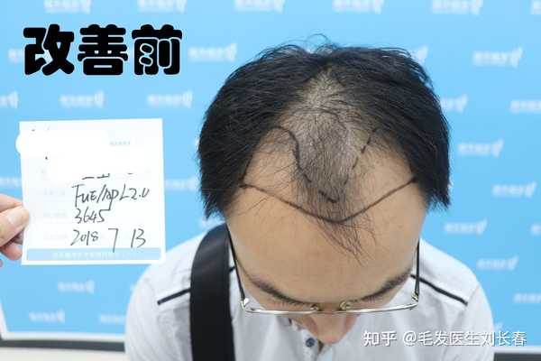 m型脱发