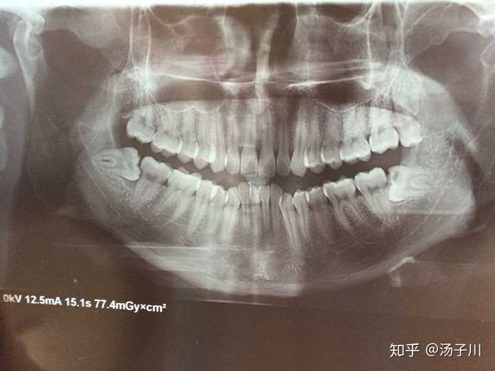 横生的智齿一定要拔除吗?