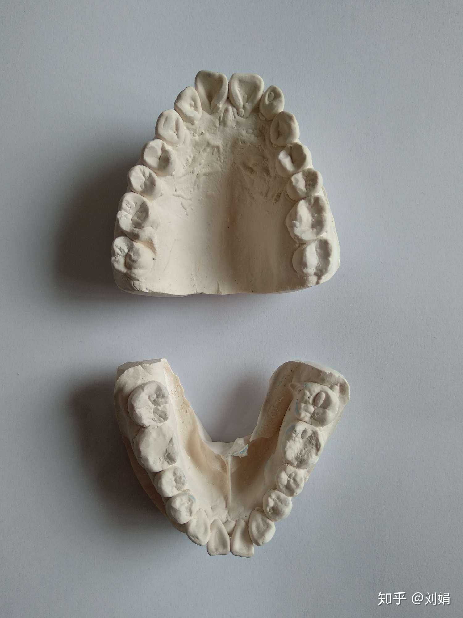 33岁大龄女性牙齿半骨性办牙性嘴突龅牙,… - 知乎