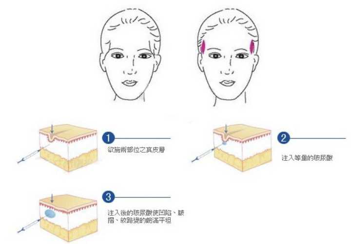 但是6到12个月左右就需要重复注射,费用较高,反正玻尿酸就是个烧钱