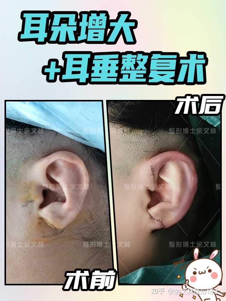 余文林整形博士 的想法: 耳朵增大77耳垂整复术()