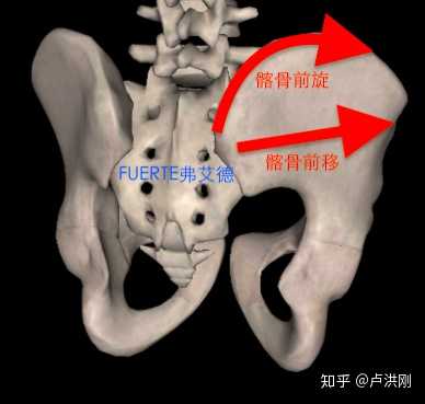 发现骨盆右前旋怎么办?