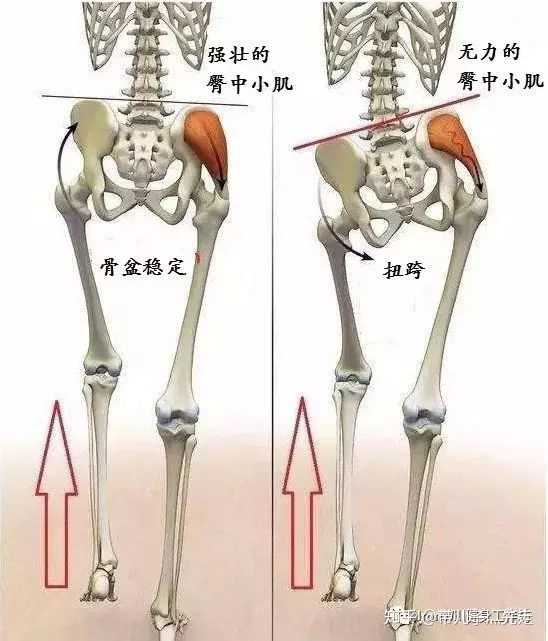 个人猜测左右臀部肌肉不对称导致,弱的一边无力是可以引起走路出现一
