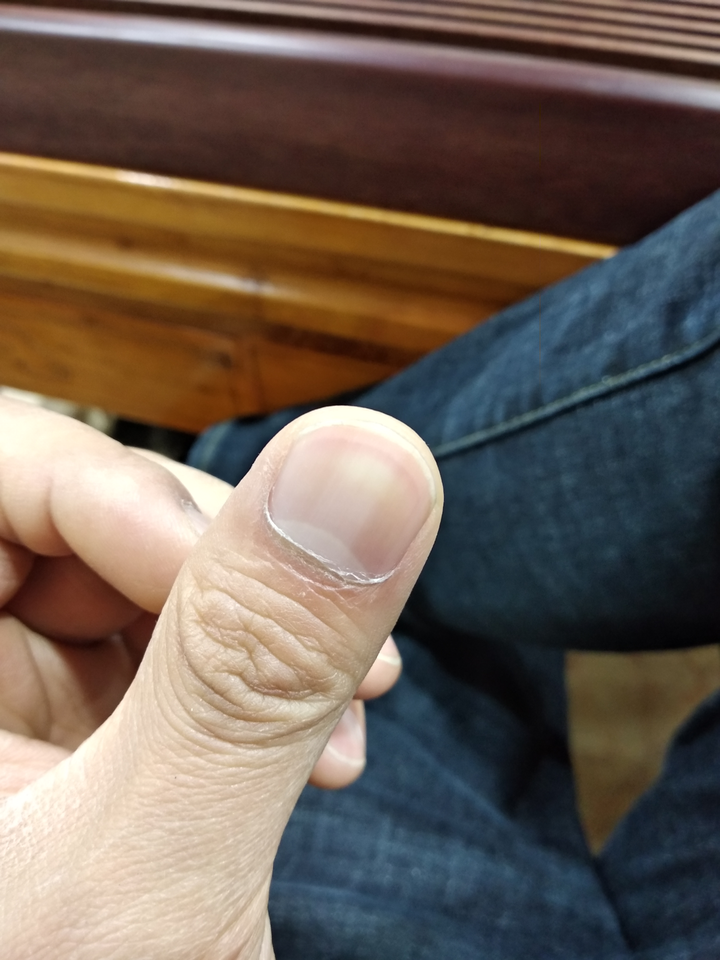手指甲中间白色竖块是怎么了?