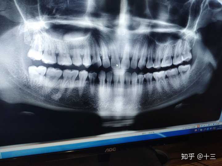 你们都是几岁开始长智齿的,长了几颗?