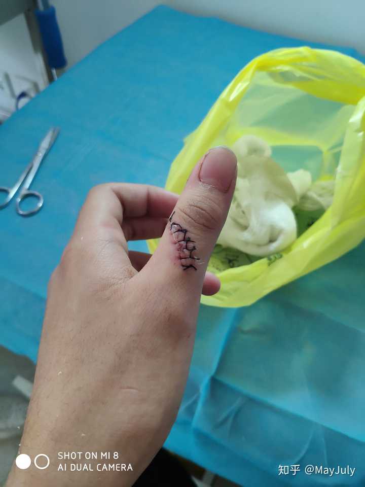 缝针和拆线可怕吗?疼吗?你们当时怕吗?