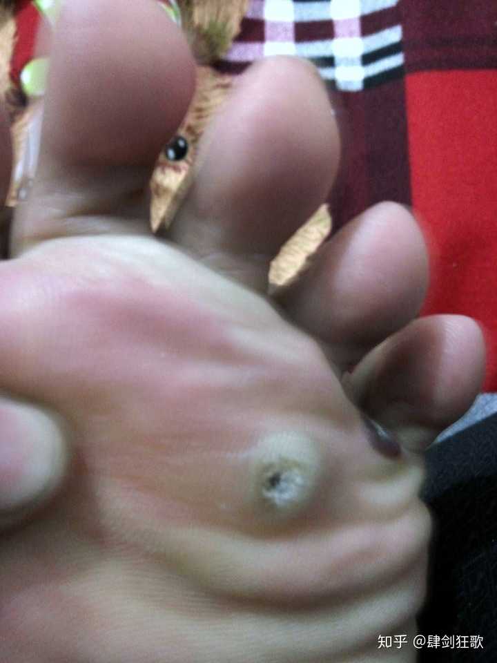 鸡眼怎么彻底挖出?