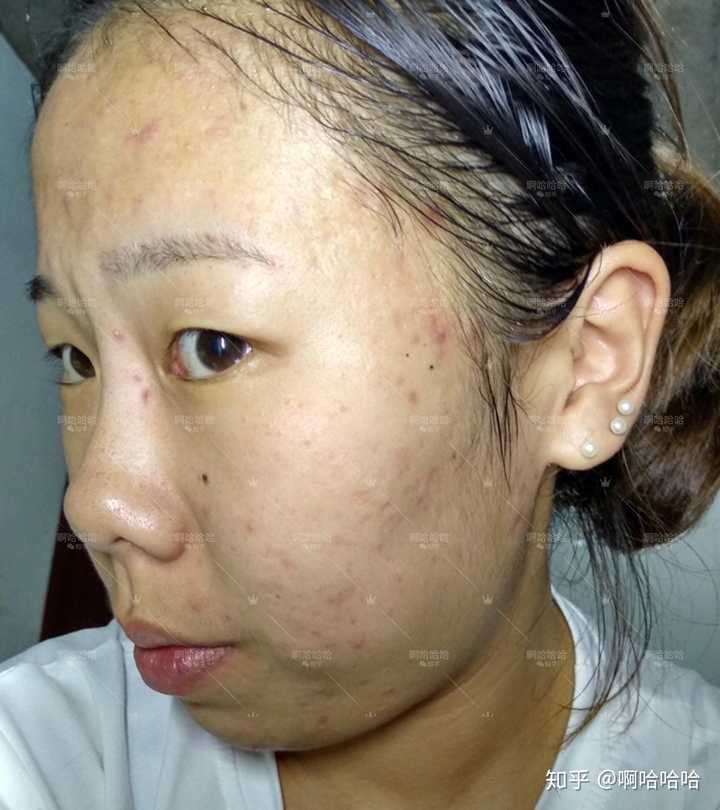 囊肿型痘痘怎么治?