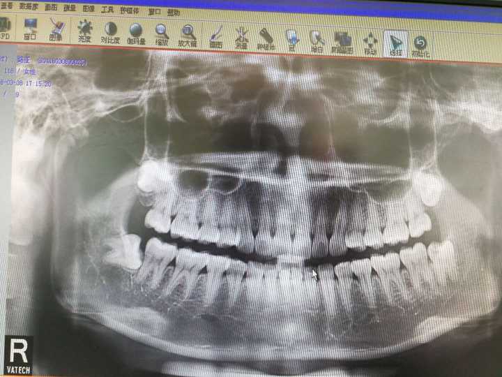 这是在口腔医院拍的全脸片子,张了四颗智齿,医生说要全拔掉