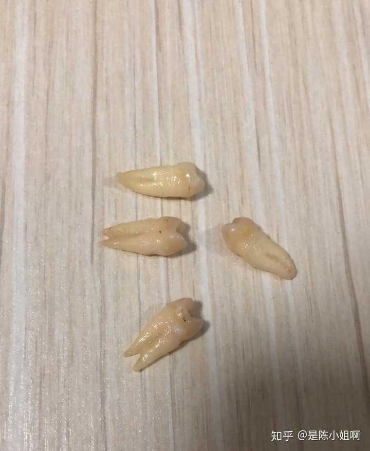 我当时第一反应就是要拿回去做纪念,毕竟是自己身上掉下来的,于是牙医
