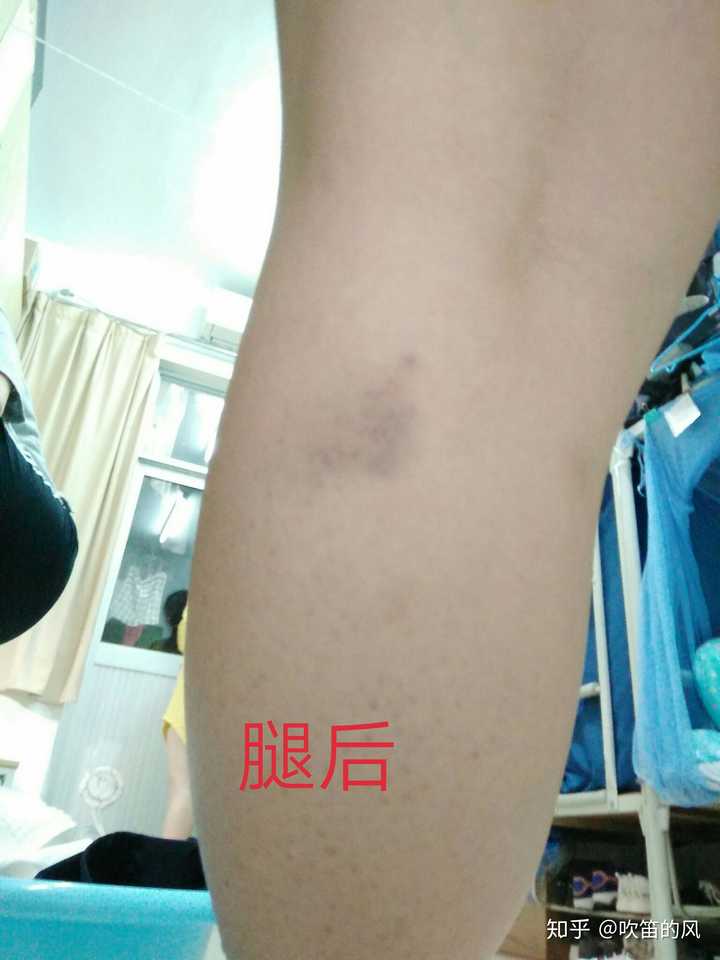 身上总会莫名其妙起淤青是什么原因?