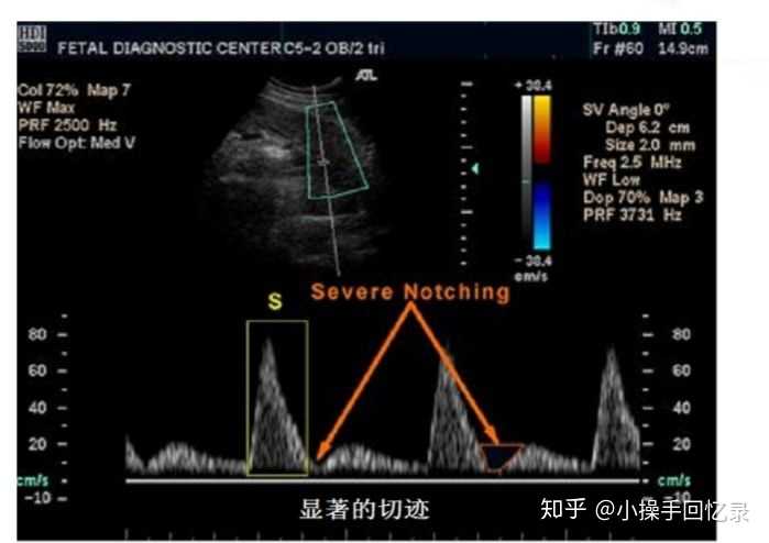 子宫动脉频谱.