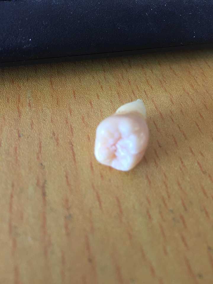拔智齿是种怎样的体验?