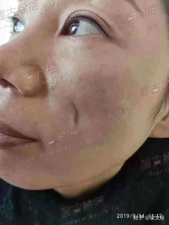这个凹陷疤痕在脸上有六七 年?