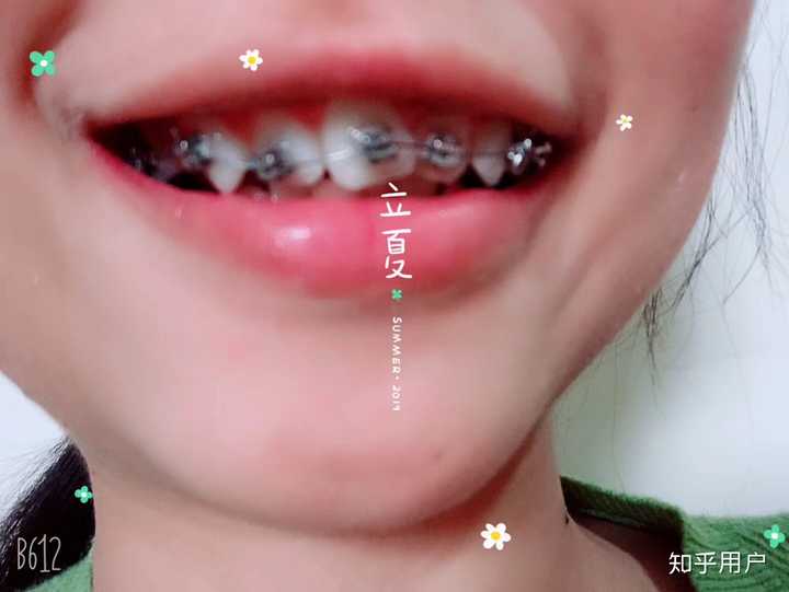 慢慢的牙齿长在了一起,所以非专业看不出来少了一颗牙,但是中缝是歪的