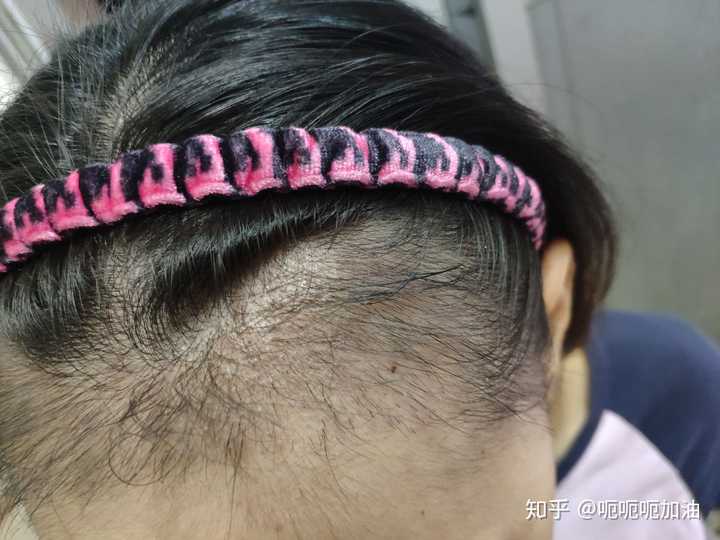 两个半月了 还是有很多头发没长出来 祈祷快快长出来