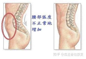 腰部弧度过度的增大,会挺肚子,会对椎间盘压迫更重,会使椎间孔变窄,会