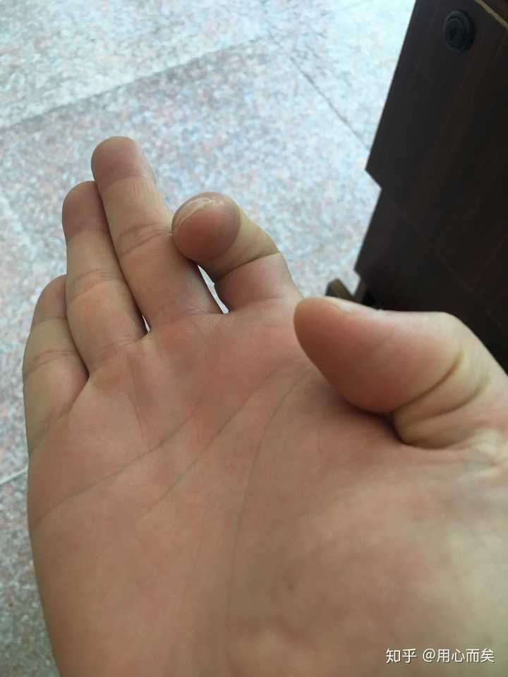 为什么我的右手大拇指和食指只能同时弯曲?