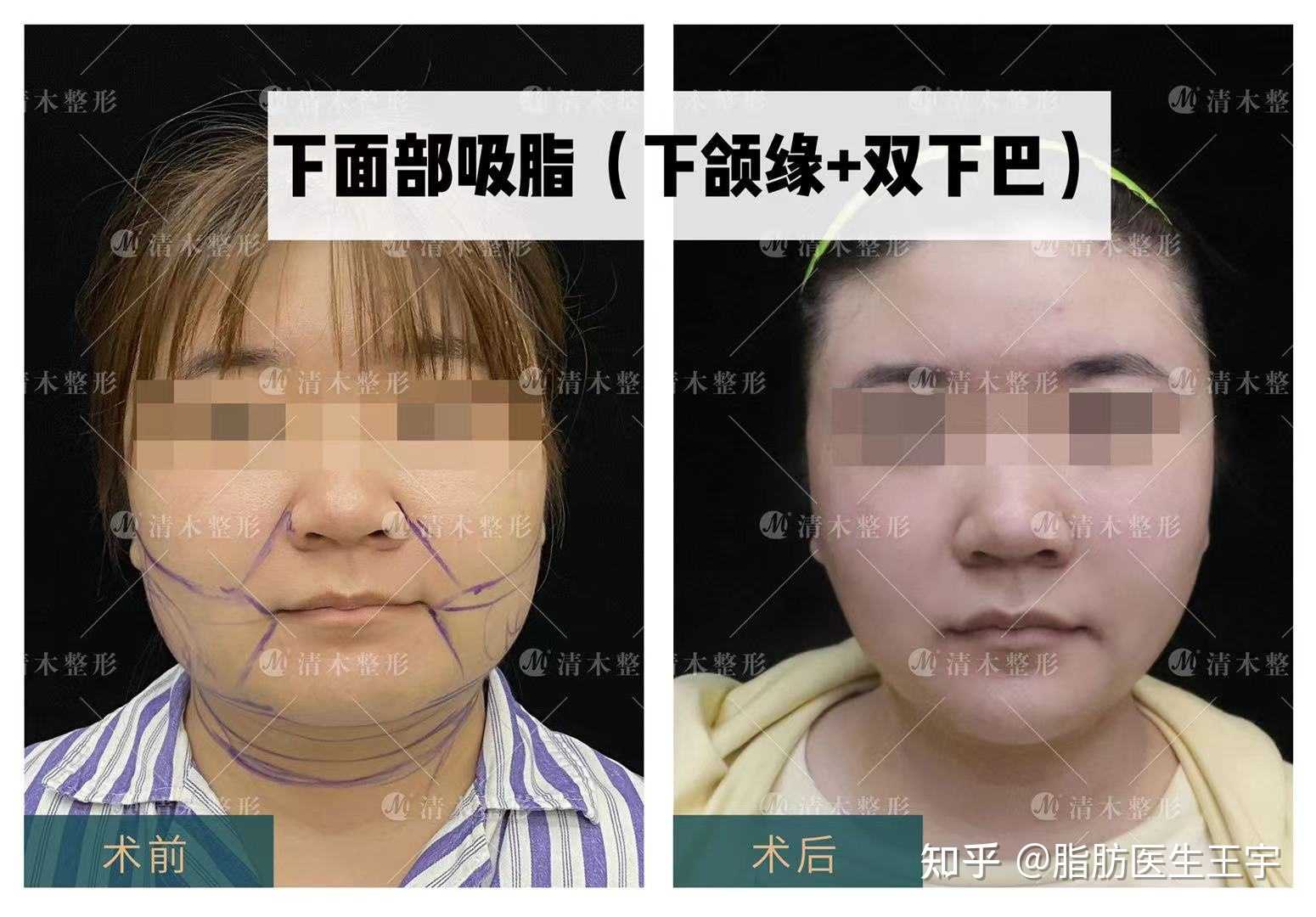 下面部吸脂下颌缘双下巴