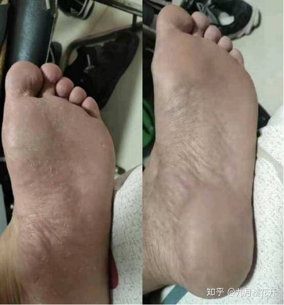 手汗脚汗多什么原因?怎么调理?