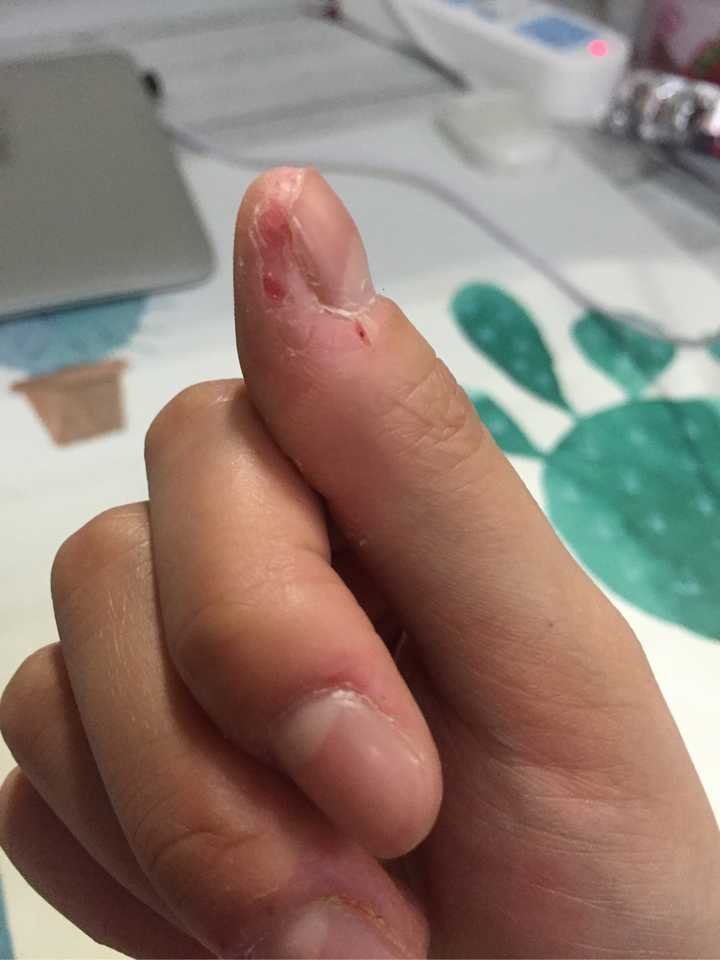 如何控制不自觉的没完没了的撕手皮?如何恢复手指皮肤的状态?