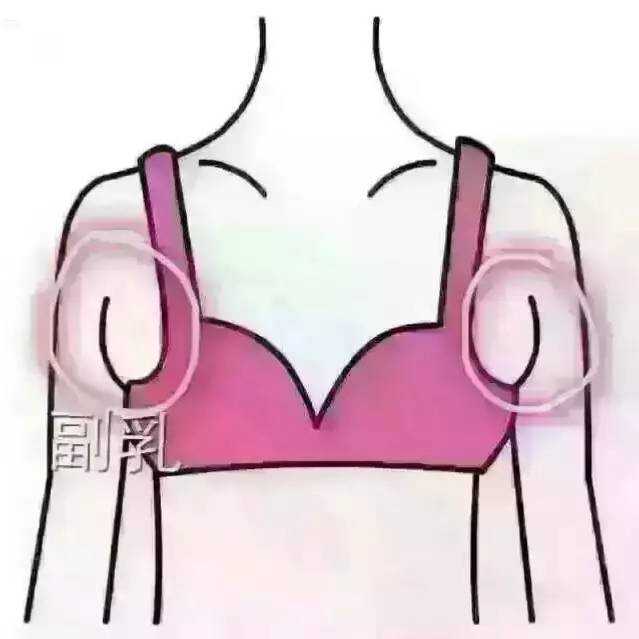 医学上的副乳指的是一种由于遗传导致的乳腺退化不完全的先天性发育