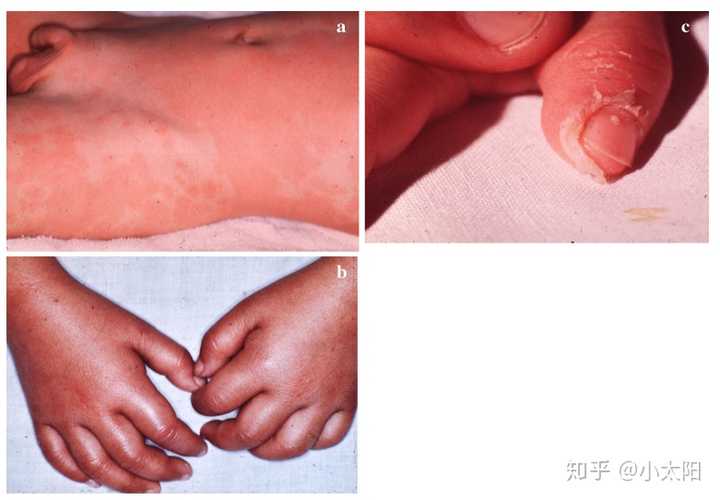 猩红热典型临床表现(a 全身多形性红斑 b 手硬结性水肿 c 指尖膜