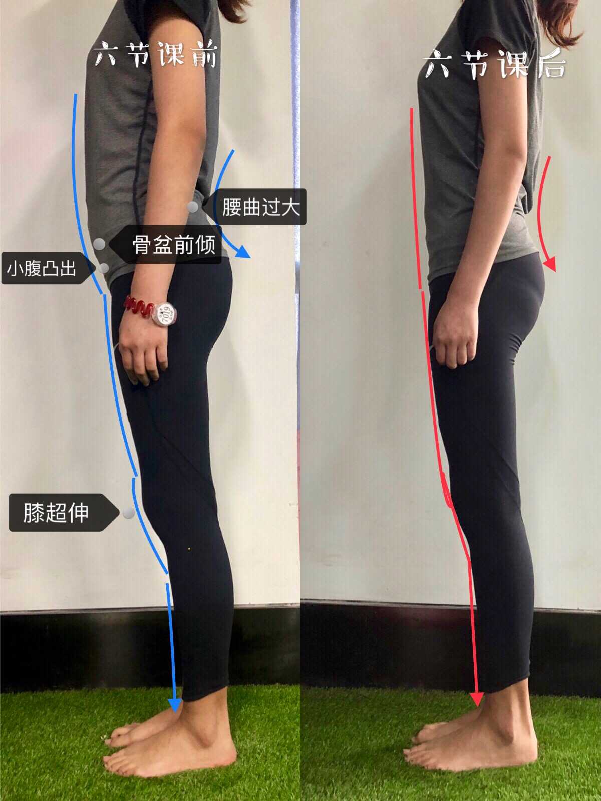 骨骼内旋导致x型腿,同时造成假胯宽,和扁方臀.