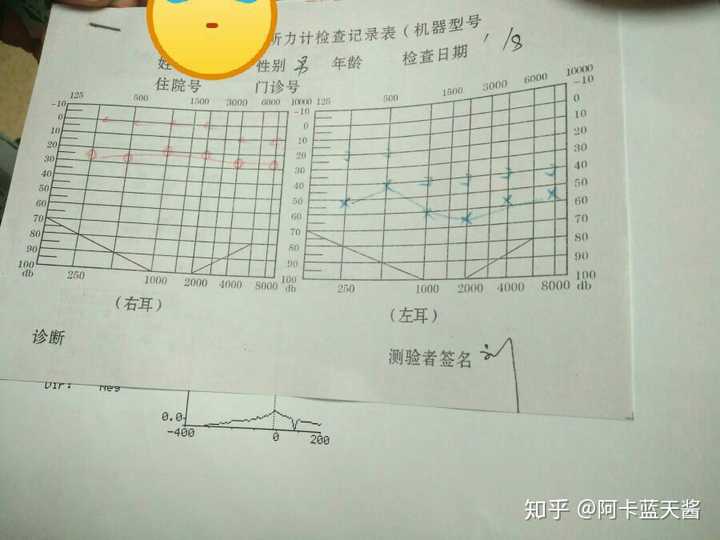 左耳没有什么异常,就是左耳听力差.医生说神经性耳聋.