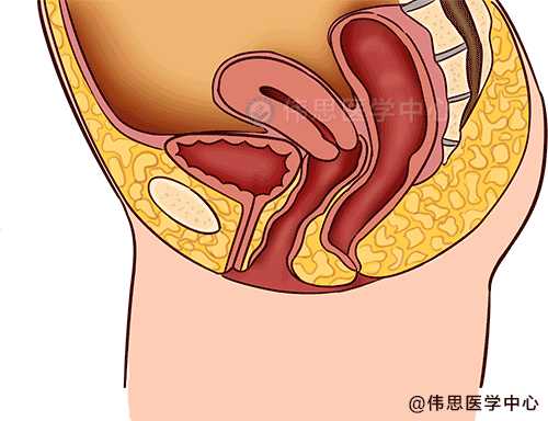 子宫脱垂的致病原因是什么该如何预防和日常护理呢