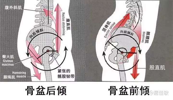 臀桥可以改善骨盆后倾还是骨盆前倾?